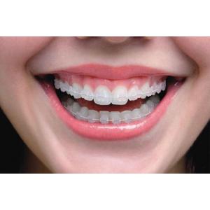 ORTODONTİK TEDAVİDE ESTETİK TELLER